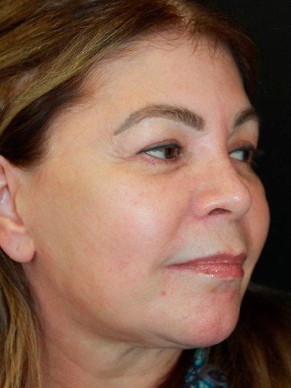 Antes: Blefaroplastia, Deep Plane e Deep Neck