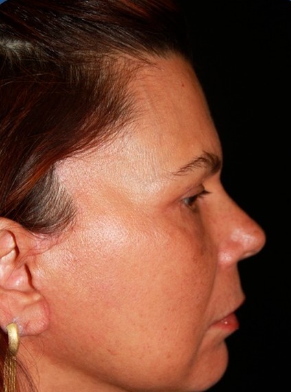 Depois: Deep Neck, vista de perfil